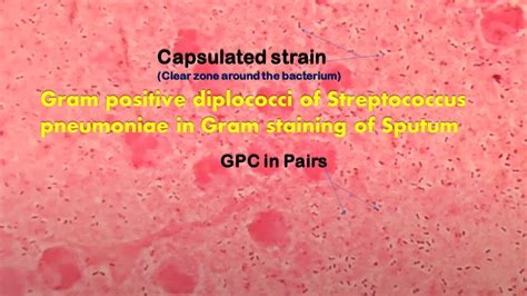 Gram Positive Cocci In Pairsgram Postive Dipococci And Pus Cells Of