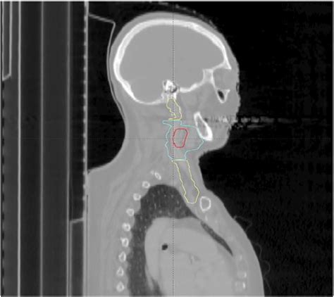 Safety Of Differential Radiation Dosing In Lymph Node Positive Necks