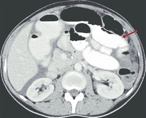 Contrast Enhanced Computed Tomography Scan Of The Abdomen And Pelvis In