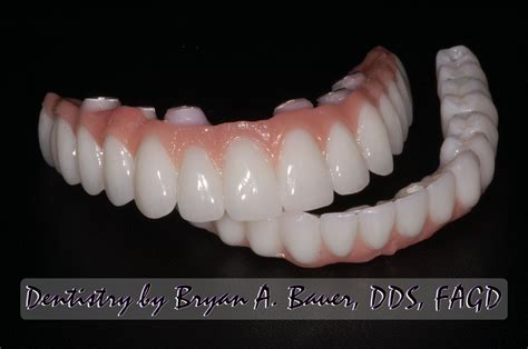 I have two 1 1/2 foot bars going across my chest and it hasn't set. Dental code hybrid denture - Locator denture code - Hybrid ...