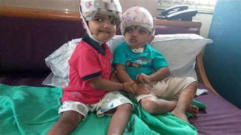 How Aiims Doctors Conducted Surgery Of Conjoined Odisha Twins Youtube