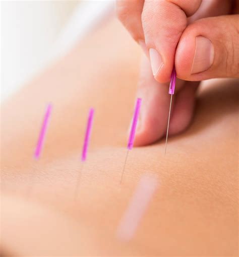 management of pelvic floor dysfunction dry needling exercise and electroacupuncture 2022