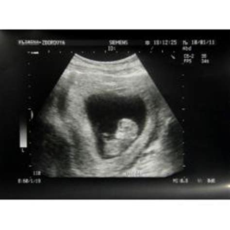 It will also show if. 11 Weeks Pregnant: Symptoms, Fetus Ultrasound, Belly Photos