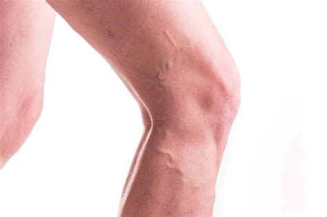 How To Get Rid Of Varicose Veins Naturally