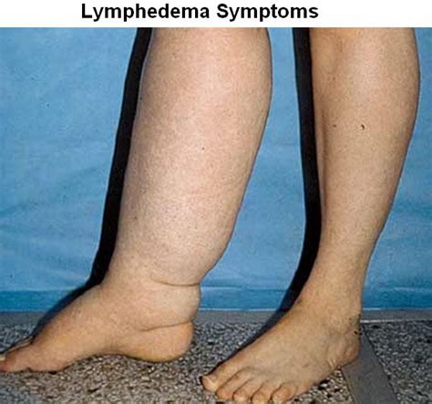 Lymphedema Causes Symptoms Treatment And Prevention Health And Beauty