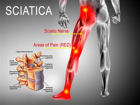 Check spelling or type a new query. Best Ways to Treat Sciatica Pain - Colorado Pain Care