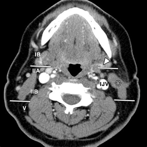 Evaluation Of Cervical Lymph Nodes In Head And Neck Cancer With Ct And