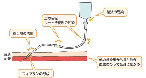 Catheter related bloodstream infection crbsi market size analysis. 中心静脈カテーテル刺入部の皮膚に発赤がなければ感染はない？｜看護roo!カンゴルー