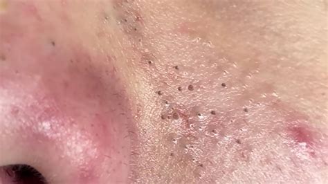 Blackheads And Milia Big Cystic Acne Blackheads Extraction Whiteheads