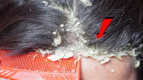 Dandruff Shampoo And Scratching Itchy Dry Scalp Huge Flake