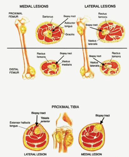 Bone Forming Bone Tumors And Tumor Like Lesions Basicmedical Key