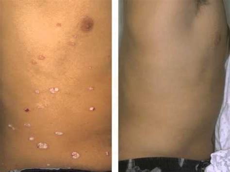 Psoriasis Before And After Treatment Youtube