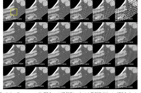 total variation stokes strategy for sparse view x ray ct image reconstruction semantic scholar