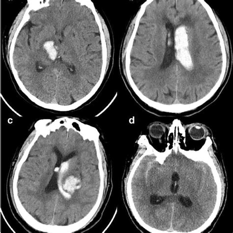 Typical Ct Images A Intraparenchymal Hemorrhage B Intraventricular