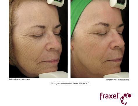 Fraxel Dual Laser Treatments Laser Skin Resurfacing