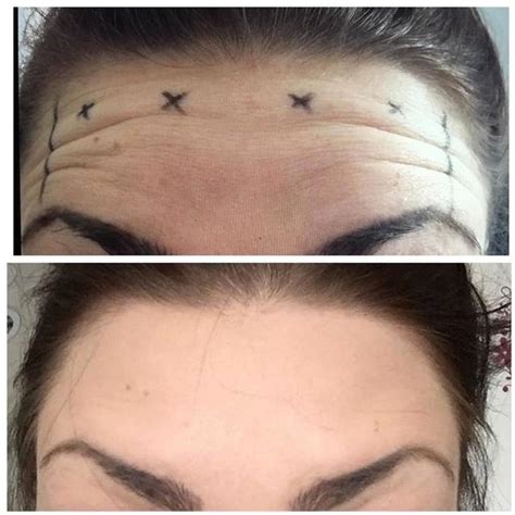 Botox Injection Forehead Wrinkles Before After 1 Facial Injections