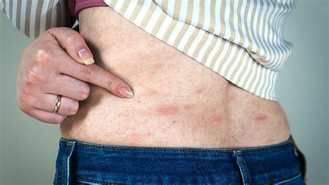 Acute And Chronic Hives And Rashes Causes And Treatments By Brynna