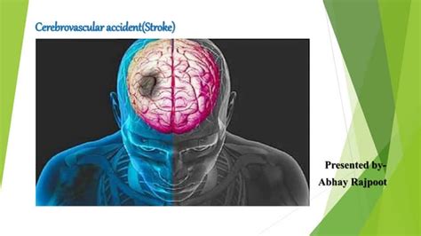 Cerebrovascular Accident Ppt