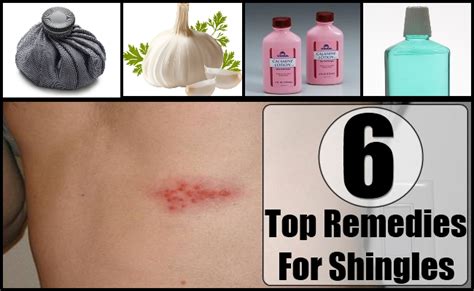 Home Remedies For Shingles Natural Treatments And Cure For Shingles