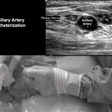 Needle Guided Ultrasound Technique For Axillary Artery Catheter