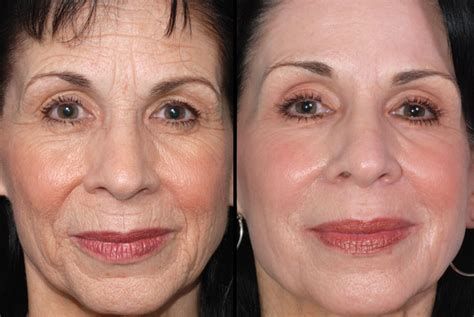 Pixel Laser Resurfacing Before And After