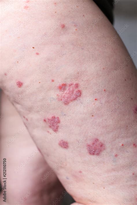 Psoriasis Vulgaris Is An Autoimmune Disease That Affects The Skin