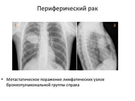 Maybe you would like to learn more about one of these? РЕНТГЕНОДИАГНОСТИКА ПЕРИФЕРИЧЕСКОГО РАКА ЛЕГКИХ Кафедра ...