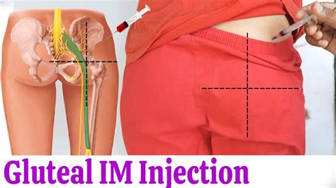 How To Give Im Intramuscular Injection In Buttock Or Hip Easily At Home Dorsogluteal