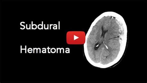 Subdural Hematoma Causes Signs Diagnosis Treatment