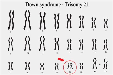 Trisomy 21 The Obg Project