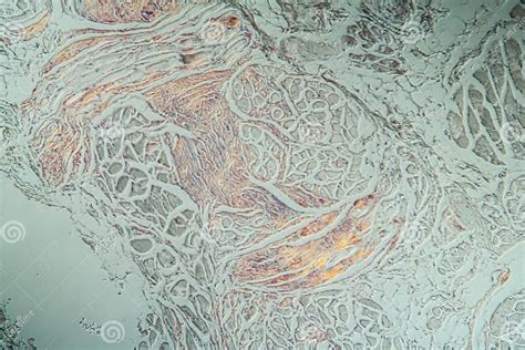 Tongue With Amyloid Deposits Of Sick Tissue Stock Photo Image Of 200x