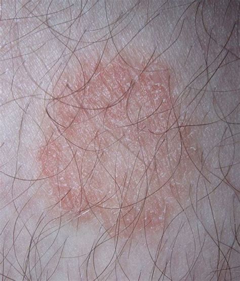 A Home Remedy For Ringworm That Works Hubpages