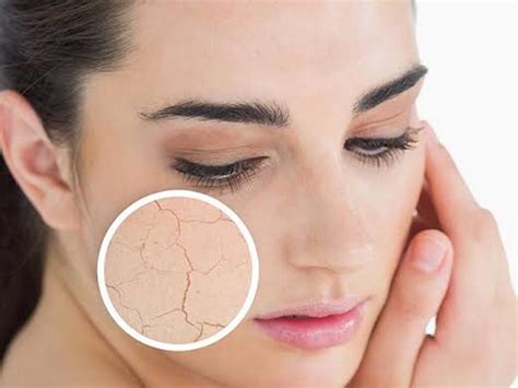 Simple Home Remedies To Get Rid Of Dry Skin You Must Try