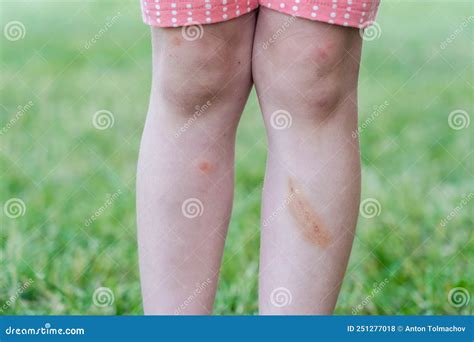 Little Child With Bruised Leg Bruise On Child Stock Photo Image Of