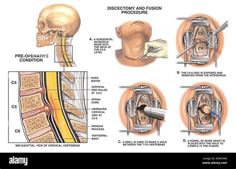 Minimally Invasive Anterior Cervical Discectomy And Fusion My Xxx Hot