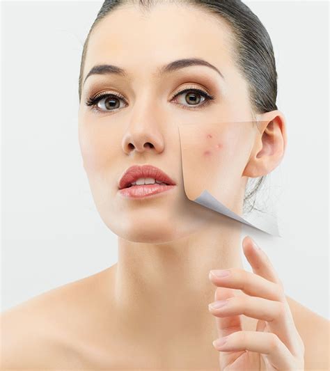 Face Treatment For Pimples Doctor Heck