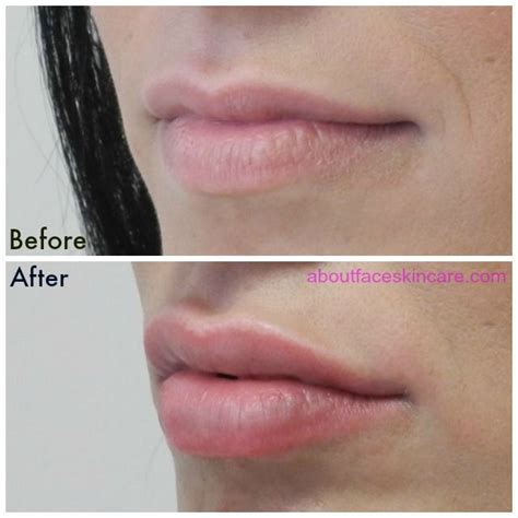 7 Simple Skin Care Tips Everyone Can Use Juvederm Lips Facial