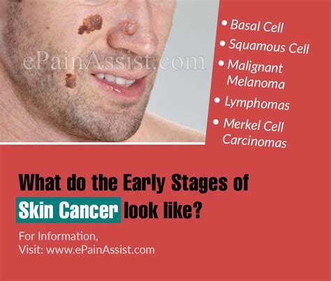 If symptoms persist for several weeks or months, it is important to see your doctor so that, if oral cancer is present, it may be diagnosed as soon as possible. What do the Early Stages of Skin Cancer look like?