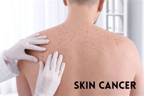 Skin Cancer Symptoms Causes Signs And Types