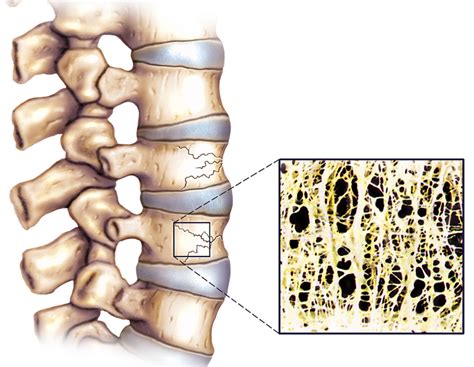 Diagnosis Of Asymptomatic Osteoporotic Fractures Using Vertebral