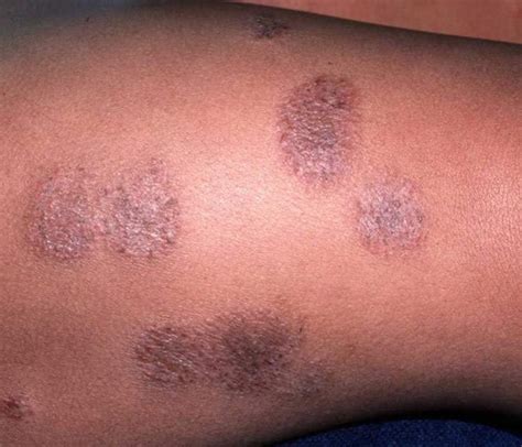 Eczema Eczema On Face Black People