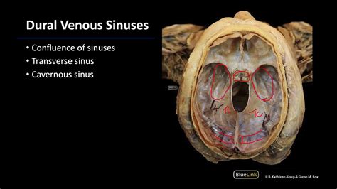 Dural Venous Sinus Dissection Supplement Youtube