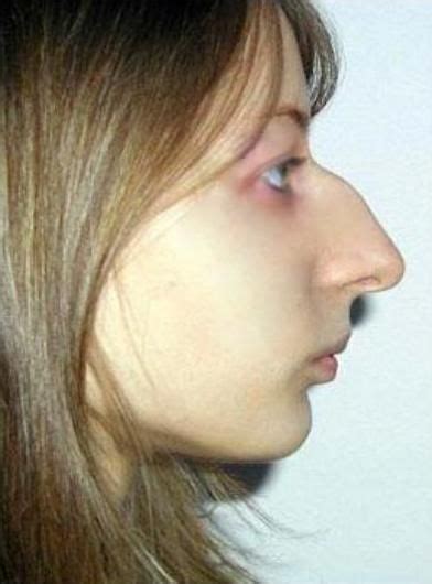 Large Jew Nose Search In 2022 Big Nose Beauty Big Noses Big Nose Girl