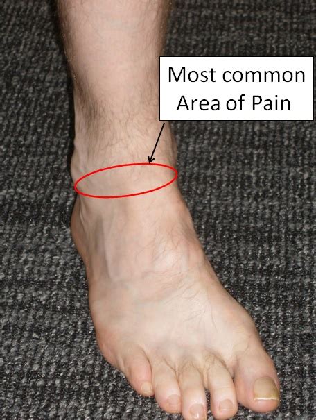 Icd 10 Code For Right Anterior Ankle Impingement