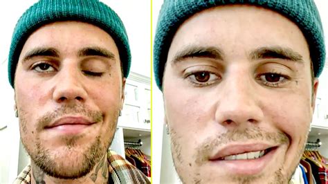 Justin Bieber Battling Virus That Paralyzed Left Side Of His Face