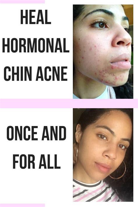 Chin Acne Causes Cystic Acne On Chin Whiteheads Remedy Breaking Out