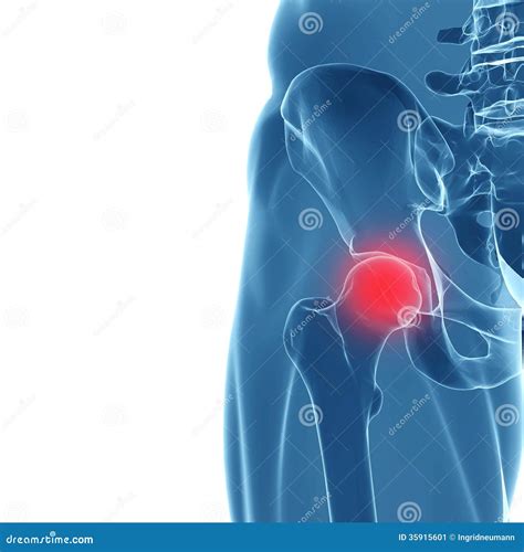 Human Hip Joint Showing Area Of Pain Stock Image Image 35915601