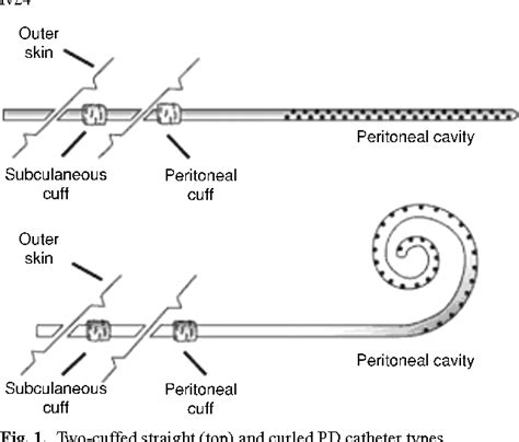 Figure From Peritoneal Dialysis Catheter Placement Technique And Complications Semantic Scholar