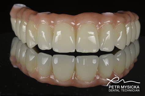 Zirconia All On 4 Bridge Brighton Implant Clinic Dental Implants