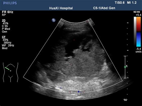 Eine myokarditis wird beim menschen bereits seit jahren als wichtiger auslöser einer gestörten myokardfunktion und herzdilatation erkannt. Eosinophilic Myocarditis due to Paraneoplastic Syndromes ...